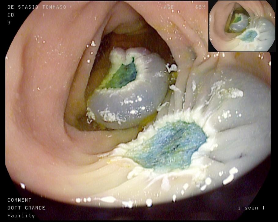 Endoscopic Versus Surgical Resection of