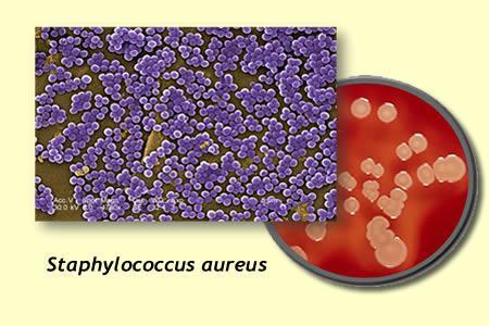 Staphylococcus aureus MRSA Infezioni della cute, tessuti molli, polmoniti, sepsi Teicoplanina registrata per l uso pediatrico in Italia Vancomicina registrata per