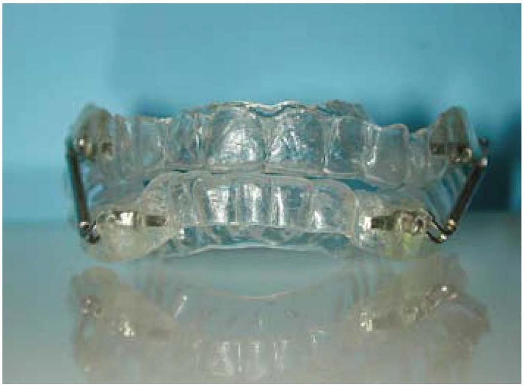 Con questo dispositivo si riesce a contenere l'allineamento dentale con le mascherine tipo Essix sia all'arcata superiore che all'arcata