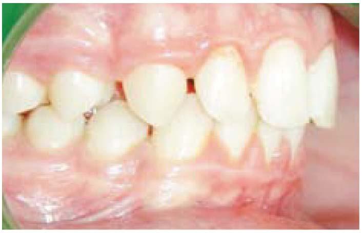 La neutralizzazione temporanea delle forze occlusali consente, così, un movimento rapido dei denti, e la