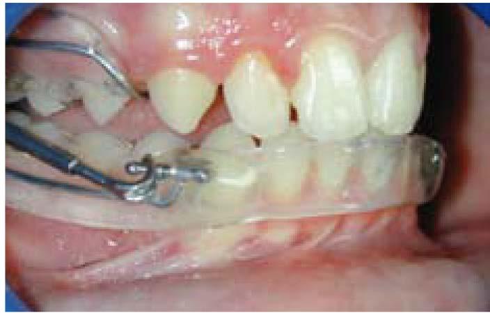 Se si considera che, in un trattamento classico fisso, i movimenti dente-alveolari provocati dagli elastici