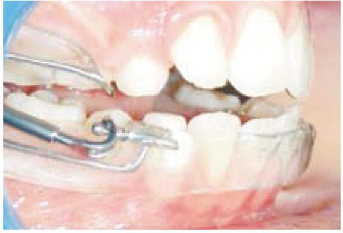 disfunzioni linguale, labiale e masticatoria (ipotonia).