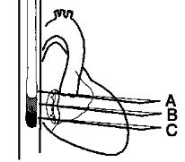 Tutti i pazienti di ambedue i gruppi sono stati sottoposti a TEE durante l intervento prima e subito dopo il bypass cardiopolmonare (figura 9). TTE TEE Figura 9.