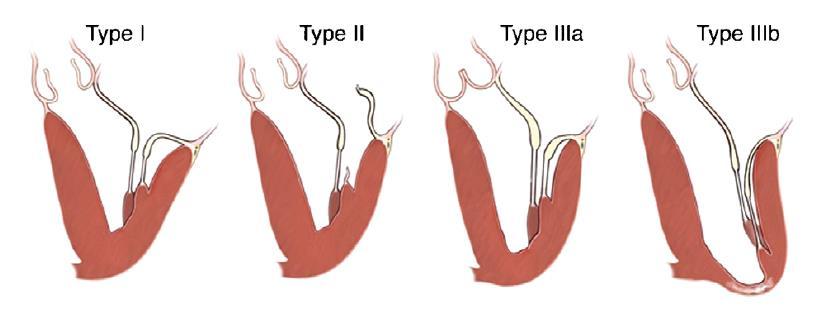 riparazione, e gli specialisti cardiovascolari hanno adottato questa classificazione perché promuove una chiara comprensione reciproca tra il chirurgo e chi esegue l ecocardiogramma.