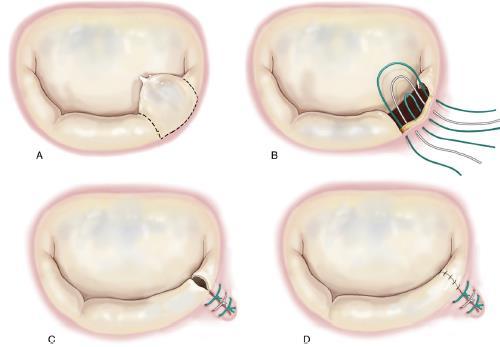 Costruzione di neocorde Il prolasso a livello delle commissure è stato trattato con una delle tecniche descritte o con