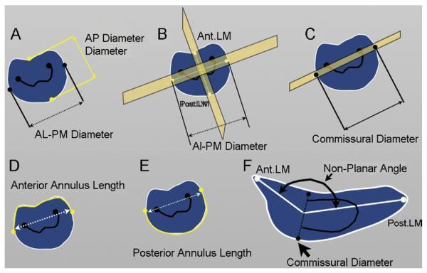 Immagini 3D di prolasso a livello della commissura (A, B, C) o dell intera valvola (D, E, F) L apparecchio e dotato di un