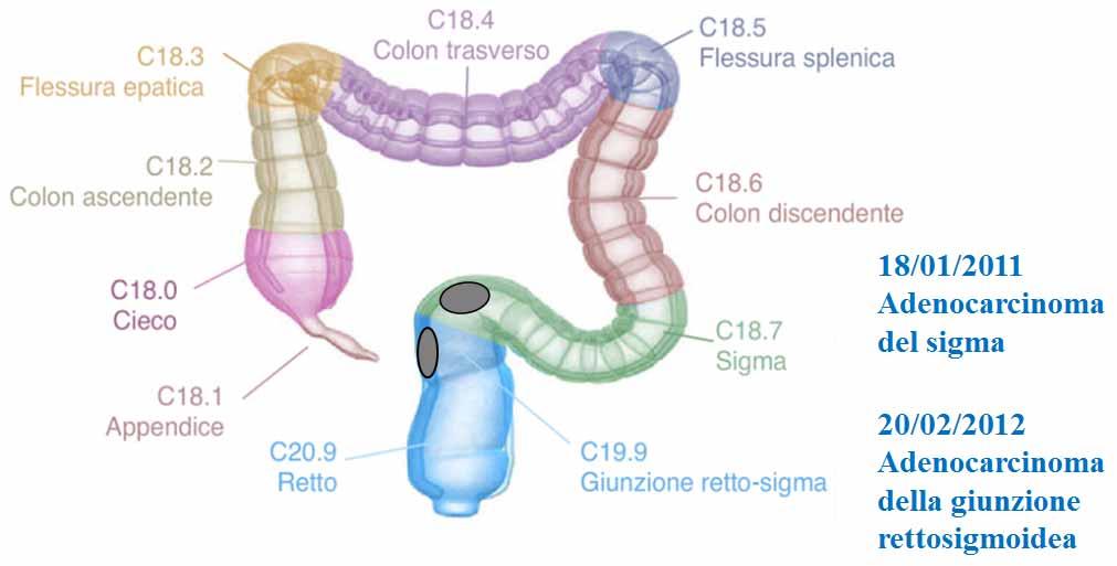 Esempio 2 In caso di due localizzazioni maligne, insorte a distanza di tempo, una al livello del colon sigmoideo e l altra al livello delle giunzione retto sigmoidea prima di considerare i