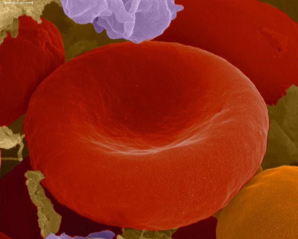 Globulo rosso umano: disco biconcavo diametro circa 7 µm Nelle anemie si ha