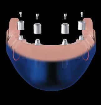 Ricollocare le cappe di guarigione agli abutment e fissarle con le apposite viti.