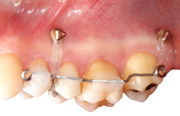 Merli f Principi di ortodonzia pre-protesica f Individuazione dell unità di