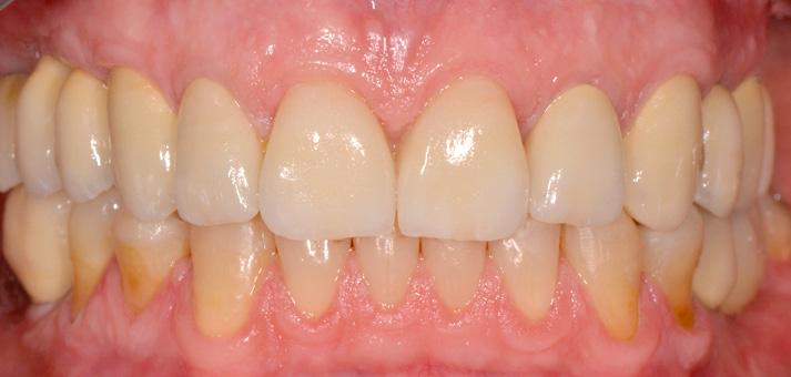 Bernardelli f Il rapporto tra substrati dentali e cementi f Restauri diretti ed indiretti f I denti