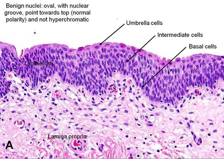 ISTOLOGIA NORMALE L urotelio si compone di diversi strati di cellule poliedriche. 5-7 cellule in vescica contratta e 2-4 cellule in vescica dilatata.