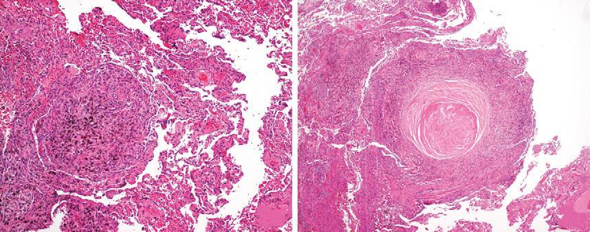 A Silicosi Anatomia Patologica B Nodulo silicotico in fase iniziale costituito da macrofagi carichi di silice (A) e nodulo