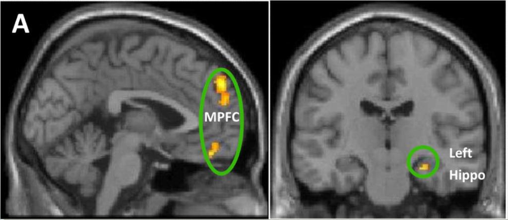 STRESS E BENESSERE PSICOLOGICO 14 MCI randomizzati a Mindfulness Based Stress Reduction vs.