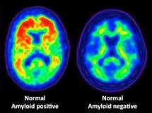 FATTORI DI RISCHIO: AMILOIDE 10-30% degli anziani sono positivi alla PET amiloide (aumento della prevalenza con l aumentare dell età) Aumenta il