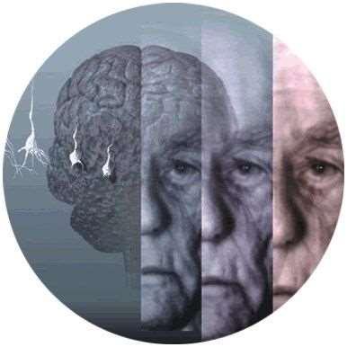 La malattia di Alzheimer Decorso 10-15 anni Fase iniziale Iniziale perdita