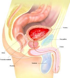 L'Ipertrofia Prostatica Benigna (IPB) consiste in un aumento di volume della prostata.