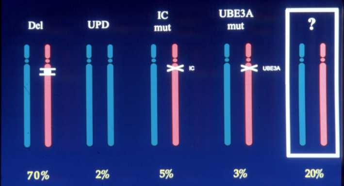 Genotipo: classi genetiche 70-75% delezione 7% UPD 2-3% mutazione del CI 11% mutazione gene UBE3A 15-20% no meccanismo genetico Delezione: 4 Mb, cromosoma 15q11-13,