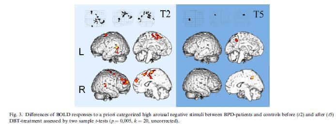 Nei soggetti responders (N=4): riduzione dell'attivazione in amigdala e ippocampo. Potrebbe essere considerato un miglioramento nella regolazione emozionale automatica.