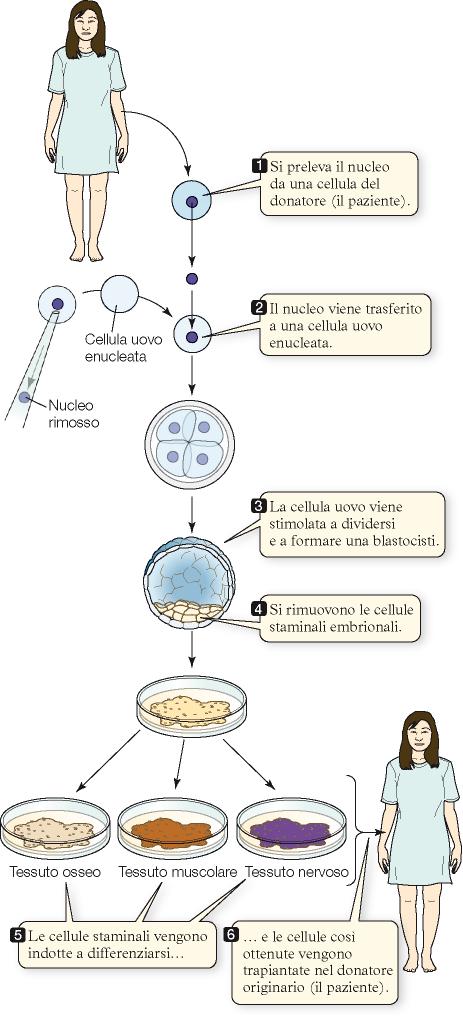 Clonazione terapeutica Il nucleo di una cellula uovo donatore viene rimosso e sostituito con il nucleo di una cellula adulta, cellula somatica.