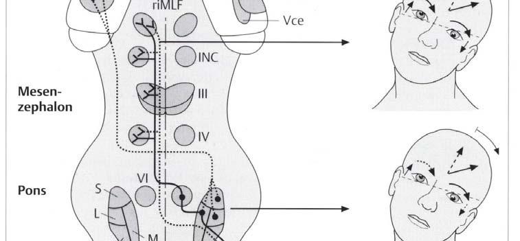 OTR ASSENTE o VARIABILE comunque sempre alterata la VVS OTR CONTROLATERALE Da lesione dopo l incrociamento ponto midollare Lesione nucleo interstiziale di Cajal Lesione mesencefalica Lesione