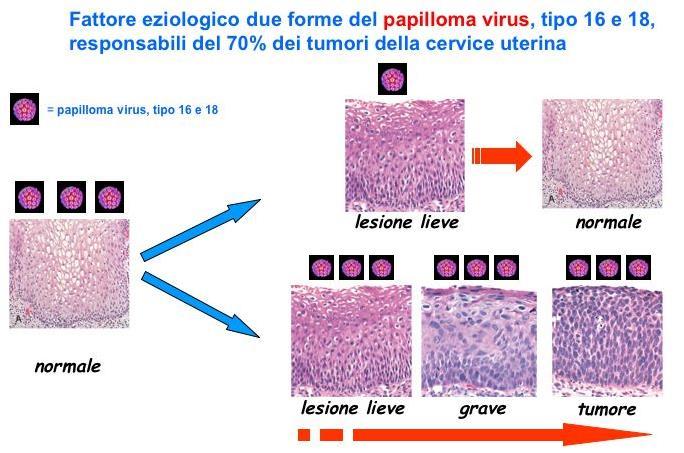 LE LESIONI PRE-NEOPLASTICHE DELLA