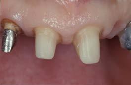 Terzo incontro - due giorni Preparazioni dentali - Ricostruzione del dente devitalizzato 1.
