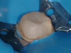 2. Ricostruzione del dente trattato