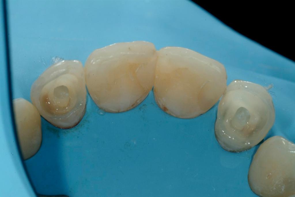 pre-endodontica del pilastro protesico: perché e