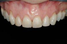 usure dentali (quando e come riabilitarli) Faccette palatine nei pazienti