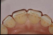 4. Preparazione dentale Faccette classiche vs faccette additive: strategie di trattamento Disegno della preparazione dentale in base alla situazione clinica e al materiale scelto Gestione dei