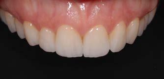 Ottimizzazione della cementazione adesiva: trattamento della superficie dentale e della faccetta Scelta del materiale da