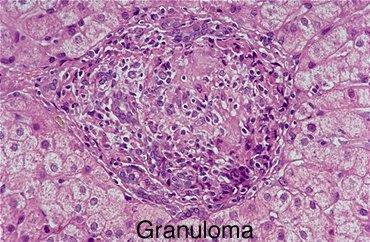 2. Infiammazione cronica granulomatosa Un granuloma è un area focale di infiammazione cronica contenente cellule epitelioidi (macrofagi attivati con prevalente attività esocitica)