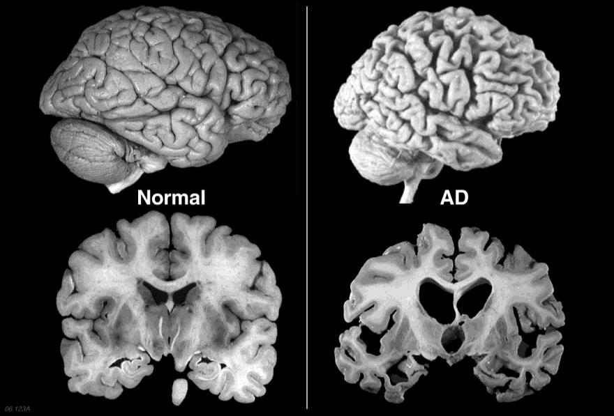 Alterazioni nel Sistema Endocannabinoide nella Malattia di Alzheimer Analisi post-mortem di cervelli di pazienti AD: Aumento dell espressione dei recettori CB 2 nella microglia e della FAAH (l enzima