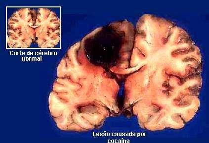 Porzione di cervello di persona dipendente da cocaina e deceduta per overdose.