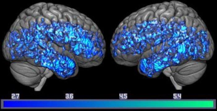 Riorganizzazione neuronale (plasticità) Esistono prove certe della stretta dipendenza tra alterazioni strutturali e alterazioni funzionali del cervello.