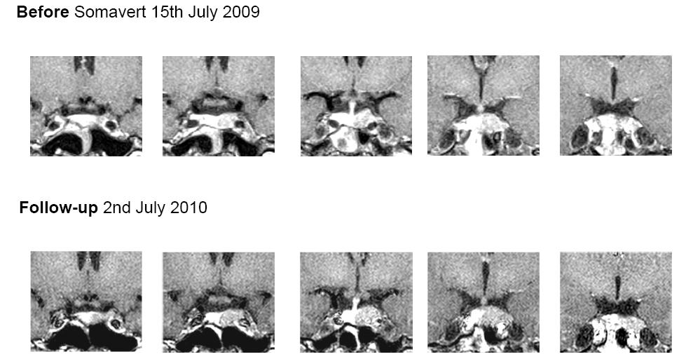 RMN per ipofisi luglio 2010 Rispe%o al precedente esame del 14/12/2009, minimo aumento delle dimensioni del macroadenoma ipofisario noto (a%ualmente 16x11x18 mm) che si estende fino al comparto