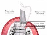 Nozioni di biomeccanica Effetti del carico meccanico sulla connessione impianto-abutment. Analogia fra leve di 1 grado e varie tipologie di protesi supportate da impianti.