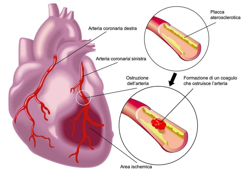 Infarto del miocardio Prolungata riduzione del flusso