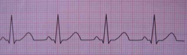 Ritmo Sinusale Il termine ritmo sinusale definisce quel ritmo cardiaco che inizia nel nodo senoatriale, (SA) la parte del cuore che regola fisiologicamente la sequenza di attivazione elettrica