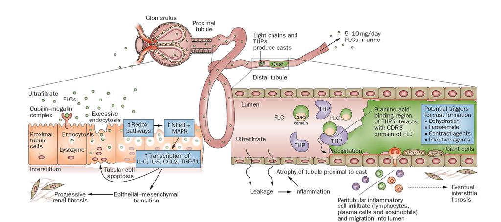 Malattia renale e tipologia di malattia plasmacellulare TEMPO IN