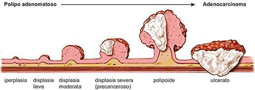 Sequenza adenoma - carcinoma Polipo o adenoma Adenocarcinoma Crescita progressiva del polipo Con l aumento delle dimensioni ed il passare del tempo,