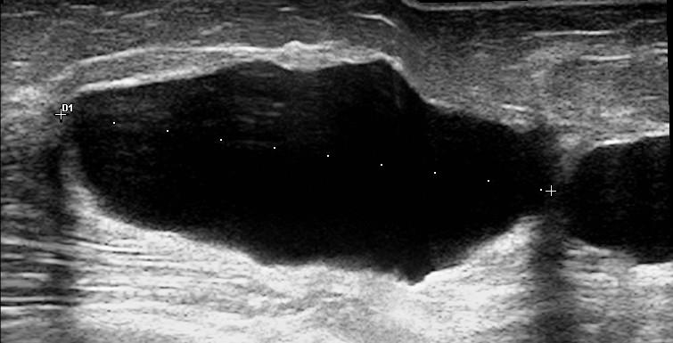 Le Cisti mammarie corpuscolate : diagnosi con elastografia Le cisti al seno "semplici" sono lesioni contenenti liquido che presentano una forma molto regolare e pareti lisce e sottili, con rinforzo