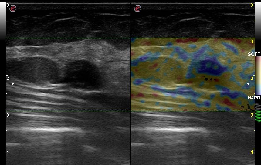 2 lesioni mammarie contigue : un fibroadenoma ed una cisti corpuscolata 2,5 mm Qui osserviamo 2 lesioni ipoecogene ovaliformi, a limiti netti e contorni regolari, quella di sinistra lievemente