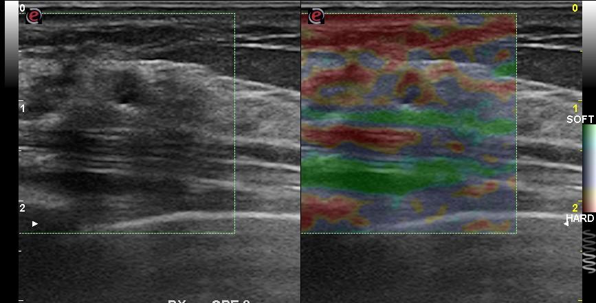 2,5 mm Piccola lesione ipoecogena rotondeggiante, a margini sfumati, senza segni di vascolarizzazione patologica né di attenuazione del fascio US.