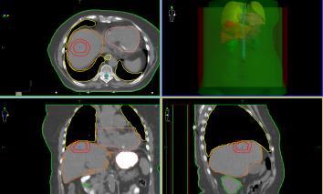 massimizzare al 95% ORGAN Healthy liver (defined as total liver