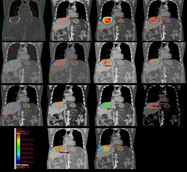 Progetto Fegato: partecipanti Experience in SBRT TPS Leaf dimensions/ collimator characteristic 1 high Eclipse 11 2,5 2 high Eclipse 11 2,5 3 high Eclipse 8,9 5 4 high Eclipse 10 5 5 high Eclipse 8.