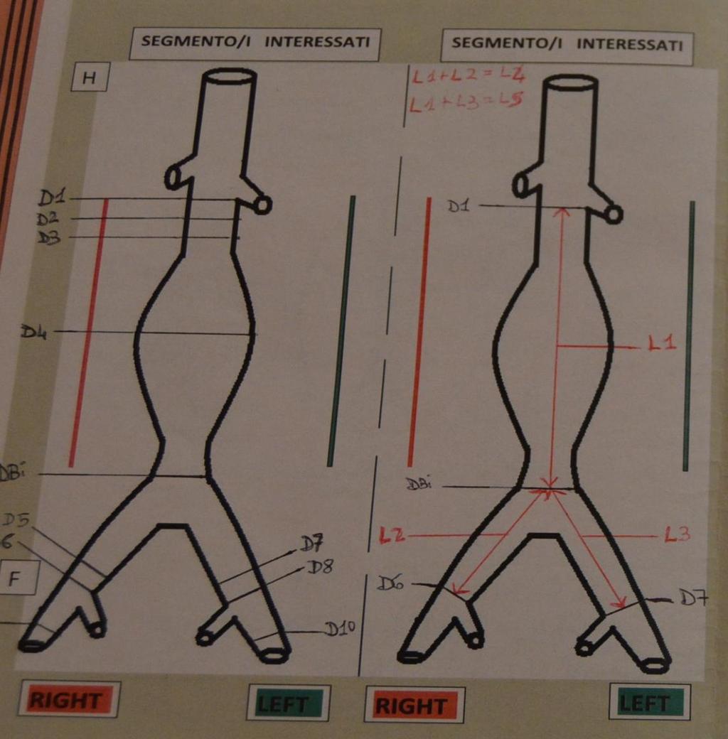 Valutazione lunghezze L1: distanza tra D1 e DBI ed equivale alla lunghezza del corpo della protesi; L2: distanza tra DBI e D6 ed equivale alla lunghezza della gamba destra