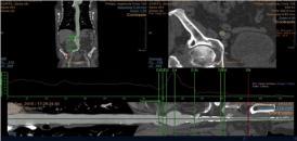 2 Robbins M, Kritpracha B, Beebe HG, Criado FJ, Daoud Y, Comerota AJ. Suprarenal endogra fixa on avoids adverse outcomes associated with aor c neck angula on.