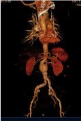 Vasc Endovascular Surg 2004; 38:401 412. Berman L, Curry L, Gusberg R, Dardik A, Fraenkel L. Informed consent for abdominal aor c aneurysm repair: the pa ent s perspec ve.